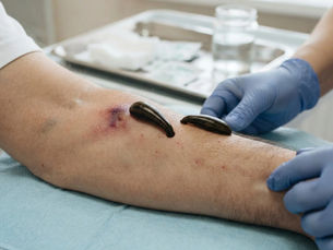 Raktamokshana- When Purification Involves Blood