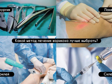 Какой метод лечения варикоза самый лучший?