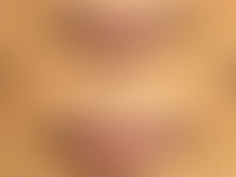 "How to Achieve Natural-Looking Lips: Avoiding the 'Duck Lips' Phenomenon"