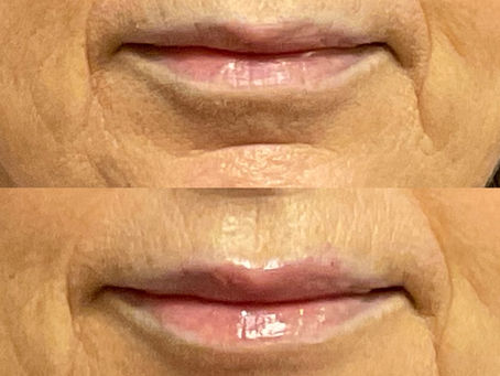 "How to Achieve Natural-Looking Lips: Avoiding the 'Duck Lips' Phenomenon"