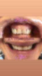 Emax crowns+composites