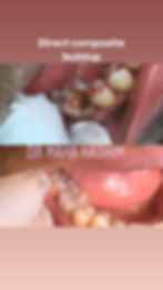 Posterior composite fillings