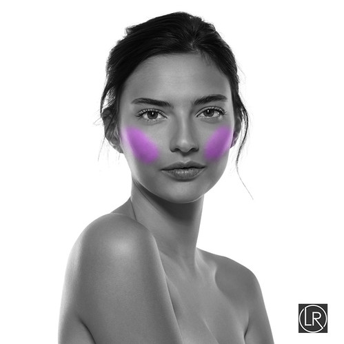 Cheeks Six | Laserremedy