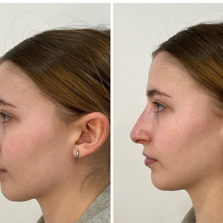 Non-surgically reshaping the nose with dermal filler to lift tip and straighten the bridge of the nose. 