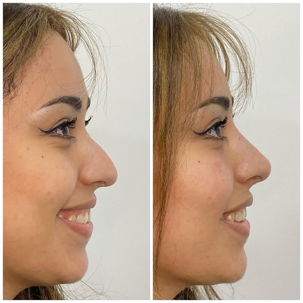 Nose tip lifting without surgery