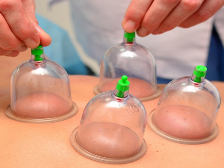 Cupping
