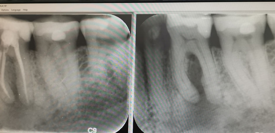 Root Canal Treatment