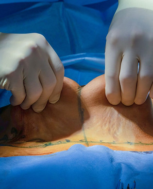 Abdominoplastia.jpg