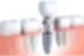 Dental implant