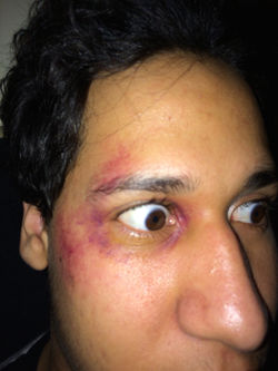 hématome (bleu) | bruise