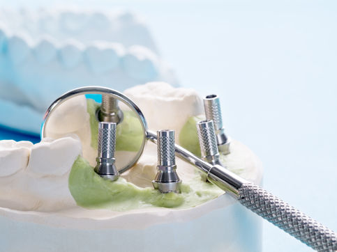 Implants for Overdentures