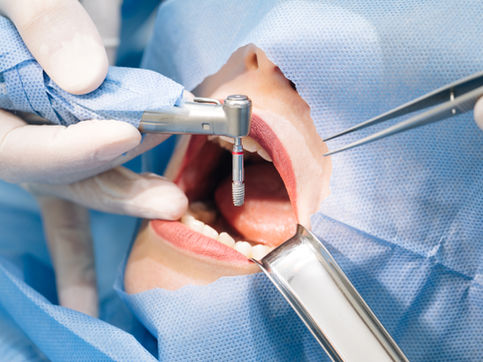 What are Implant-supported Dentures?