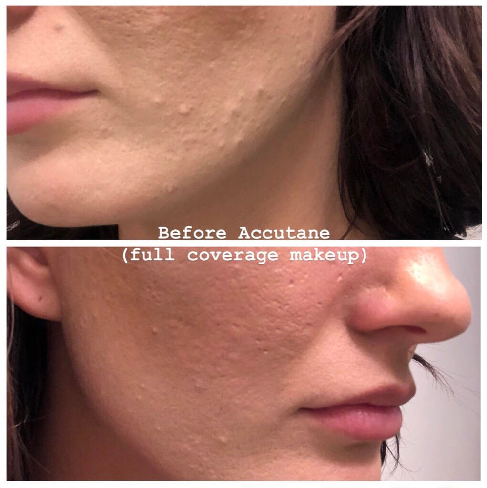 where to buy accutane in canada