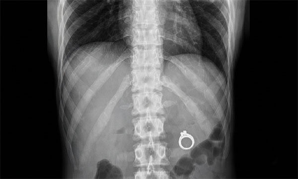 Heiratsantrag mit einem im Champagnerglas versteckten Ring