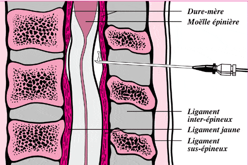 Schéma anéatomie d'une péridurale