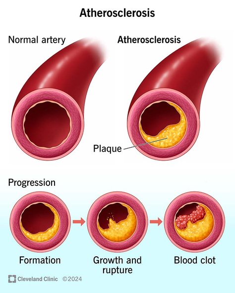 Inflammation and Your Heart: What You Should Know
