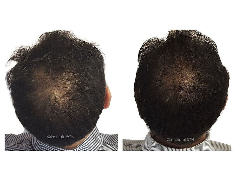 Haar voor en na een microneedling-kuur bij HairDoctors