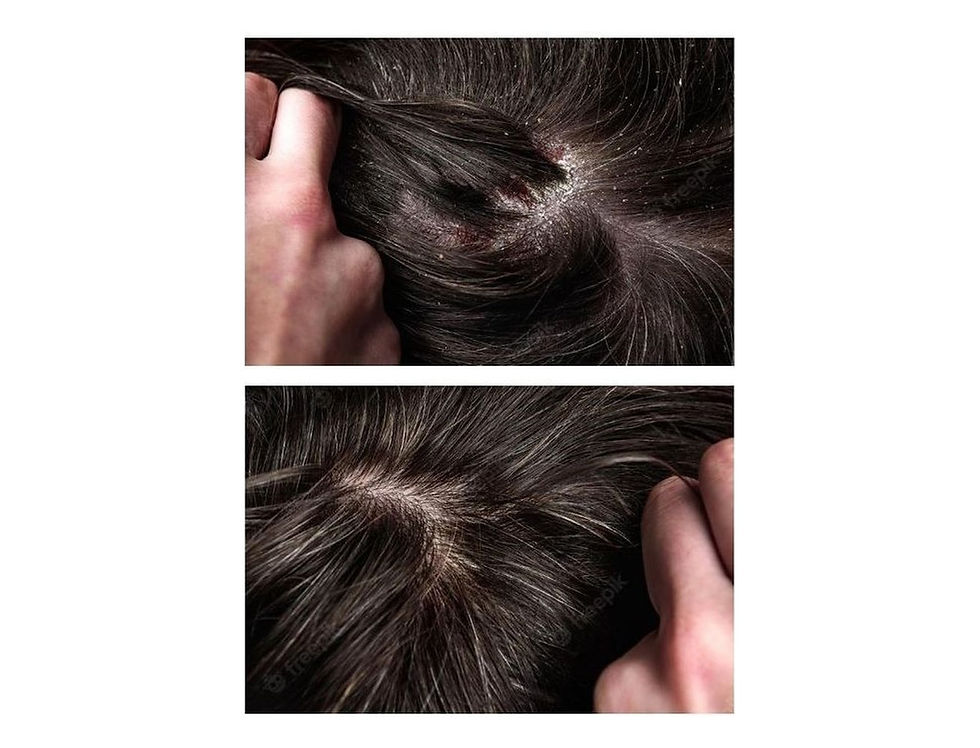 Hoofdhuid voor en na een Scalp Detox-behandeling bij HairDoctors