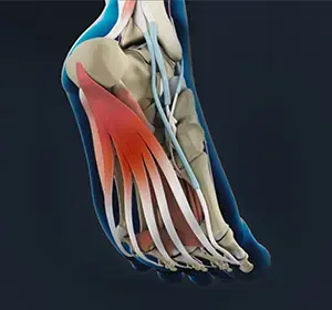 Plantar Fasciitis: Why It's Probably Not What You Think, and What Actually Helps