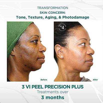 VIPeel_PrecisionPlus_BeforeandAfter2_800x800.jpeg