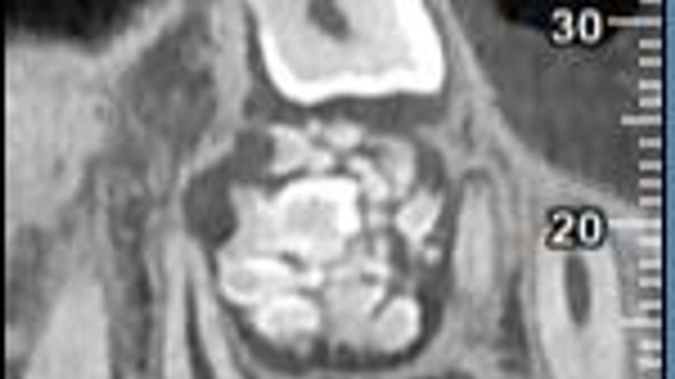 CT scan of a dental area showing impacted teeth
