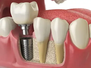 dental-implants-1-920x690.jpg.webp
