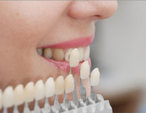 Porcelain veneers shade comparison