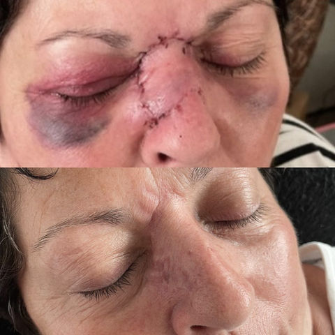 Professionelle Narbenbehandlung Stäfa