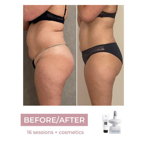 Hautfalten reduzieren Stäfa