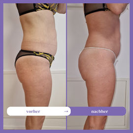 Fettreduktion Stäfa