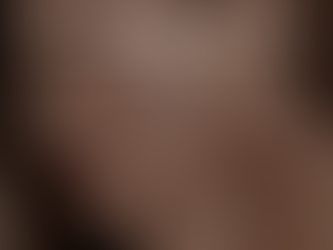 AcneLaser Treatment in Weybridge: The Advanced Solution for Oily & Acne-Prone Skin