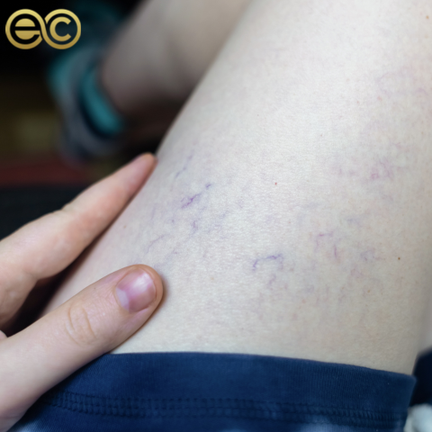 Venous Lake Treatment