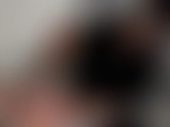 Fotona 4D LipLase Treatment: Natural Lip Enhancement Without Fillers - Eternal Clinic