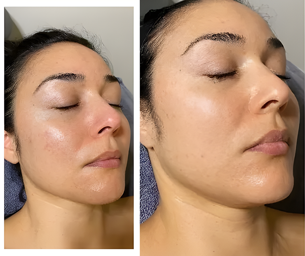 Is Microneedling Worth It in Weybridge? Results, Cost & What to Expect