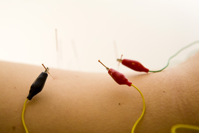 electro acupuncture.gif