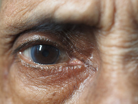 Cataract Surgery Recovery: Day-by-Day Timeline