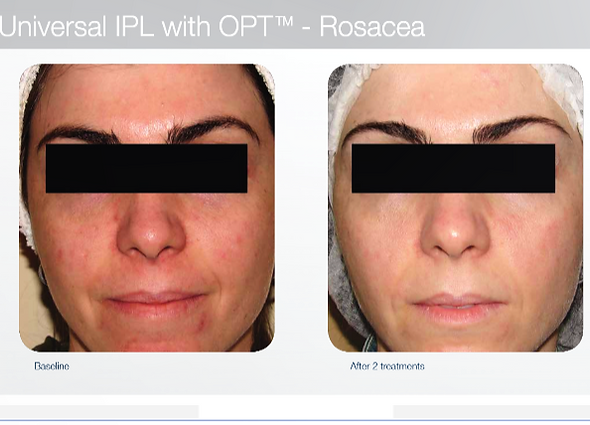 rosacea (1).png