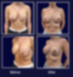 Augmentation Mastopexy