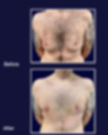 Gynaecomastia surgery