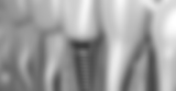Dental tooth implant embedded in a successful bone graft