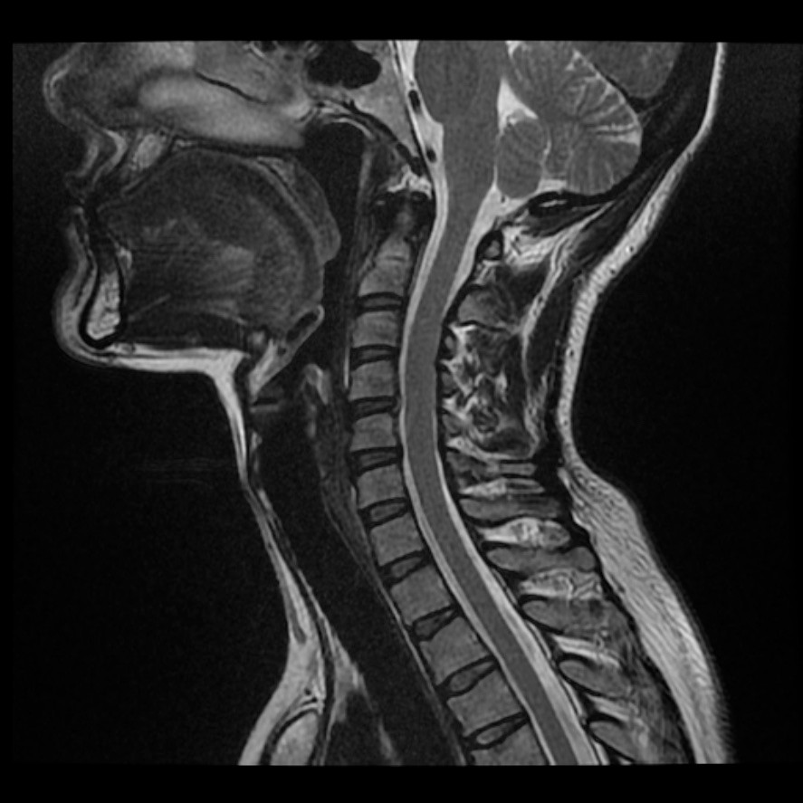 RM columna cervical