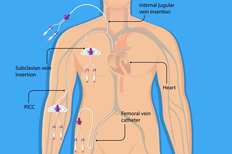 The Right Site, the First Time Which Central Line Insertion Site is Best for EM Docs?