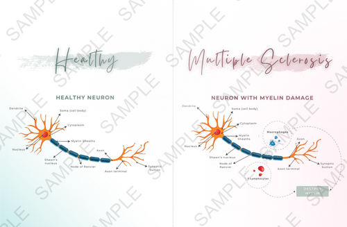 Multiple Sclerosis (printable) | Miss Medicine