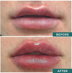 Lips before & After.jpg