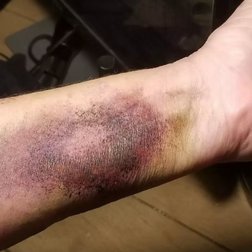 A fake bruise on the inside of a forearm looks extremely realistic, but was done with makeup.