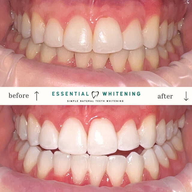 Thumbnail: Essential Whitening Take-Home Kit