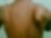 Scapular Dyskinesis