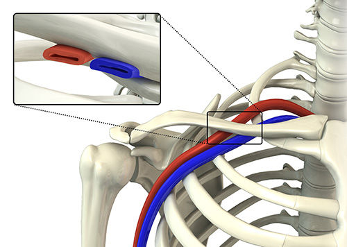 A Massage Therapists guide to Thoracic Outlet Syndrome