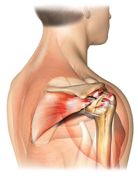 Rotator Cuff Tendonitis CPE-CPD Professional Development Study Module