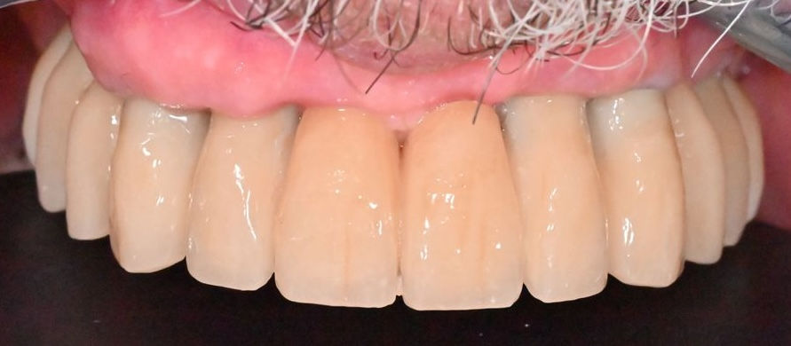 Prothèse définitive sur implants